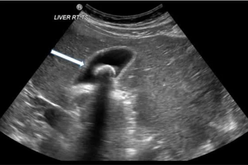 Dr Jahangir Kabir ets learn about Gall bladder stone or Cholelithiasis