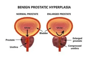 PROSTATE ENLARGEMENT by Dr Jahangir Kabir